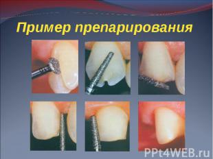 Этапы лечения зуба презентация