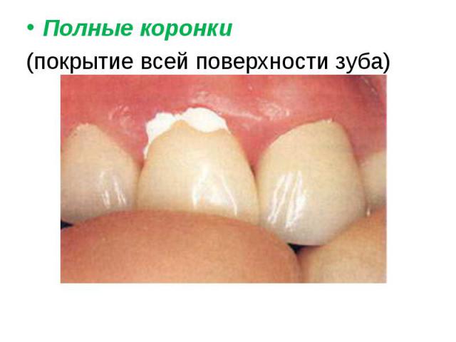 Полные коронки Полные коронки (покрытие всей поверхности зуба)