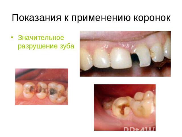 Значительное разрушение зуба Значительное разрушение зуба