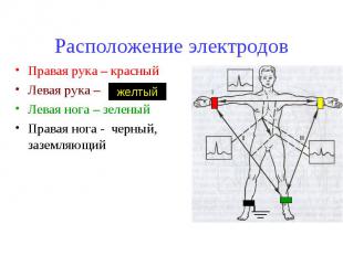 Расположение электродов Правая рука – красный Левая рука – Левая нога – зеленый