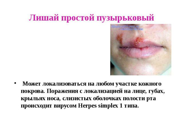 Лишай простой пузырьковый Может локализоваться на любом участке кожного покрова. Поражения с локализацией на лице, губах, крыльях носа, слизистых оболочках полости рта происходит вирусом Herpes simplex 1 типа.