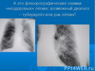 А это флюорографические снимки «нездоровых» лёгких: возможный диагноз – туберкул