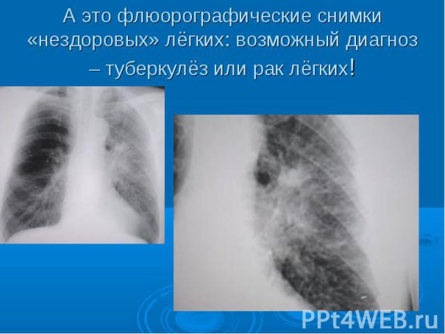 А это флюорографические снимки «нездоровых» лёгких: возможный диагноз – туберкулёз или рак лёгких!