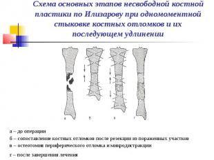 Схема основных этапов несвободной костной пластики по Илизарову при одномоментно