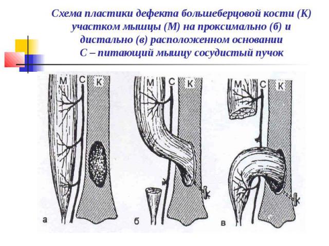 Схема пластики дефекта большеберцовой кости (К) участком мышцы (М) на проксимально (б) и дистально (в) расположенном основании С – питающий мышцу сосудистый пучок