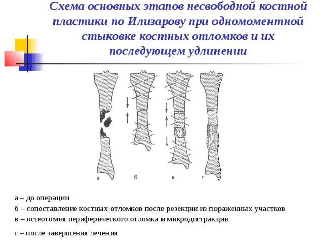 Схема основных этапов несвободной костной пластики по Илизарову при одномоментной стыковке костных отломков и их последующем удлинении а – до операции б – сопоставление костных отломков после резекции из пораженных участков в – остеотомия перифериче…