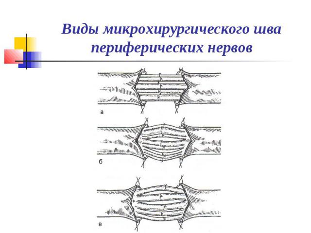 Виды микрохирургического шва периферических нервов