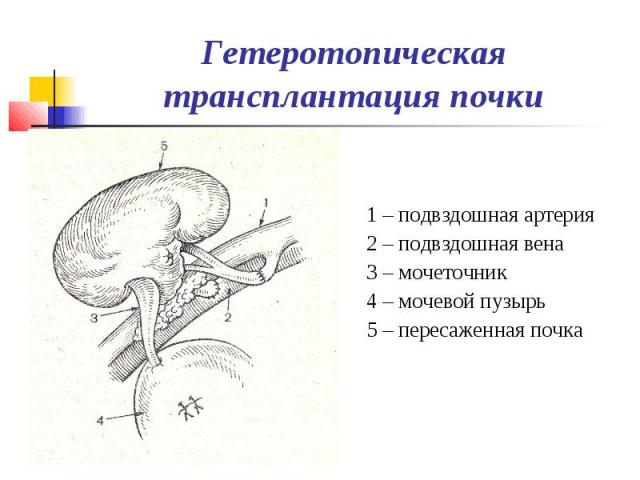 Гетеротопическая трансплантация почки 1 – подвздошная артерия 2 – подвздошная вена 3 – мочеточник 4 – мочевой пузырь 5 – пересаженная почка