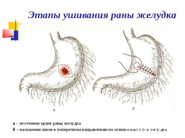 Этапы ушивания раны желудка а – иссечение краев раны желудка б – наложение швов в поперечном направлении по отношению к оси желудка