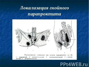 Локализация гнойного парапроктита