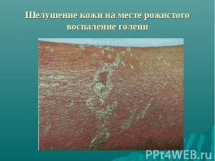 Шелушение кожи на месте рожистого воспаление голени