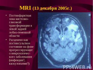 MRI (13 декабря 2005г.) Постинфарктная зона кистозно-глиозной трансформации в ле