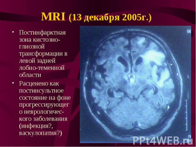 MRI (13 декабря 2005г.) Постинфарктная зона кистозно-глиозной трансформации в левой задней лобно-теменной области Расценено как постинсультное состояние на фоне прогрессирующего неврологичес-кого заболевания (инфекция?, васкулопатия?)