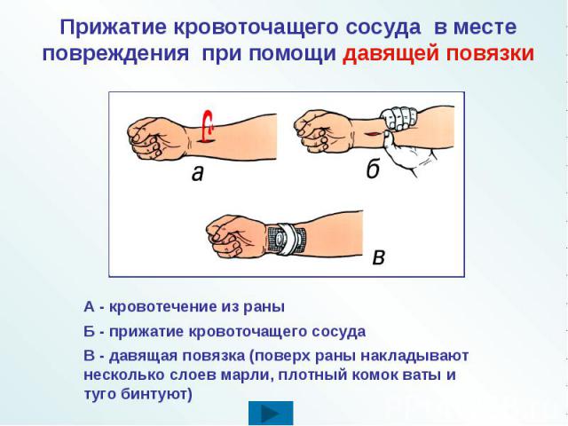 Прижатие кровоточащего сосуда в месте повреждения при помощи давящей повязки