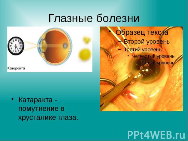 Глазные болезни Катаракта - помутнение в хрусталике глаза.