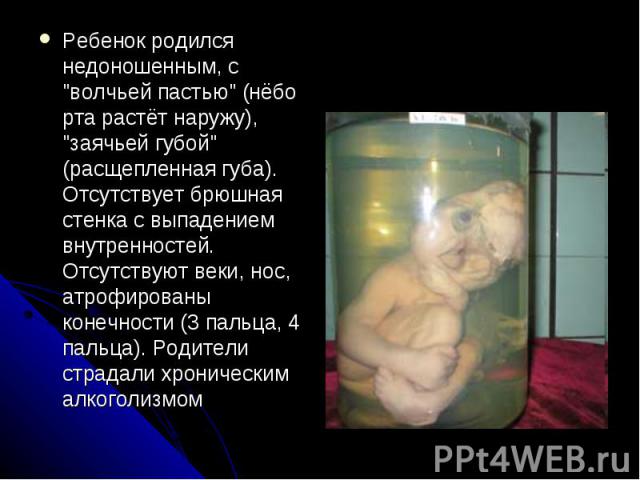 Ребенок родился недоношенным, с "волчьей пастью" (нёбо рта растёт наружу), "заячьей губой" (расщепленная губа). Отсутствует брюшная стенка с выпадением внутренностей. Отсутствуют веки, нос, атрофированы конечности (3 пальца, 4 па…