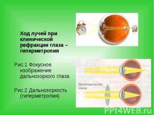 Ход лучей при клинической рефракции глаза – гиперметропия Ход лучей при клиничес