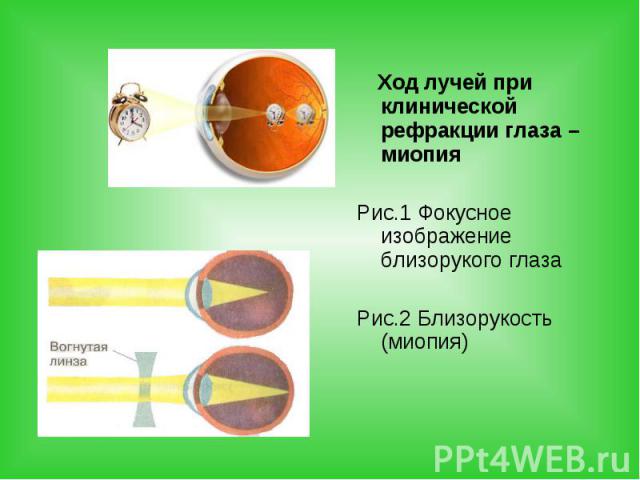 Ход лучей при клинической рефракции глаза – миопия Ход лучей при клинической рефракции глаза – миопия Рис.1 Фокусное изображение близорукого глаза Рис.2 Близорукость (миопия)