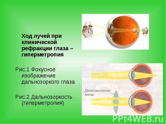Ход лучей при клинической рефракции глаза – гиперметропия Ход лучей при клинической рефракции глаза – гиперметропия Рис.1 Фокусное изображение дальнозоркого глаза Рис.2 Дальнозоркость (гиперметропия)