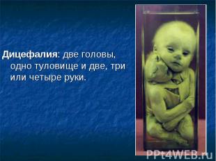 Дицефалия: две головы, одно туловище и две, три или четыре руки. Дицефалия: две