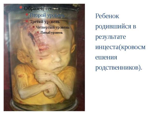 Ребенок родившийся в результате инцеста(кровосмешения родственников). Ребенок родившийся в результате инцеста(кровосмешения родственников).