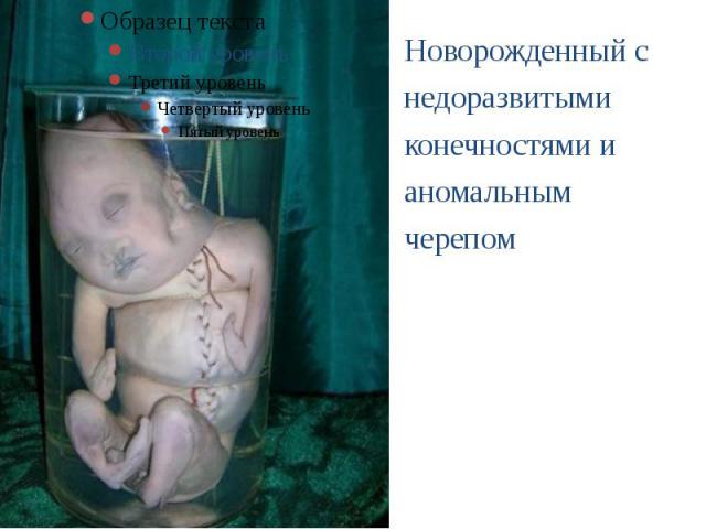 Новорожденный с недоразвитыми конечностями и аномальным черепом Новорожденный с недоразвитыми конечностями и аномальным черепом