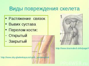Растяжение связок Растяжение связок Вывих сустава Перелом кости: Открытый Закрыт