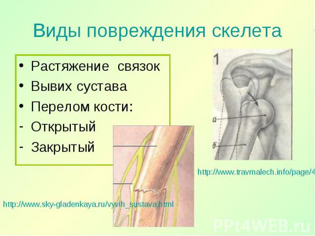 Растяжение связок Растяжение связок Вывих сустава Перелом кости: Открытый Закрытый