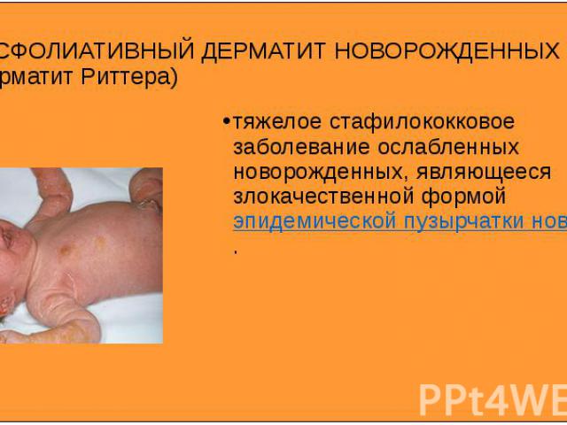 ЭКСФОЛИАТИВНЫЙ ДЕРМАТИТ НОВОРОЖДЕННЫХ (дерматит Риттера) тяжелое стафилококковое заболевание ослабленных новорожденных, являющееся злокачественной формой эпидемической пузырчатки новорожденных.