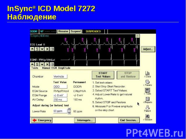 InSync® ICD Model 7272 Наблюдение