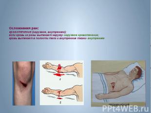 Осложнения ран: кровотечение (наружное, внутреннее); если кровь из раны вытекает