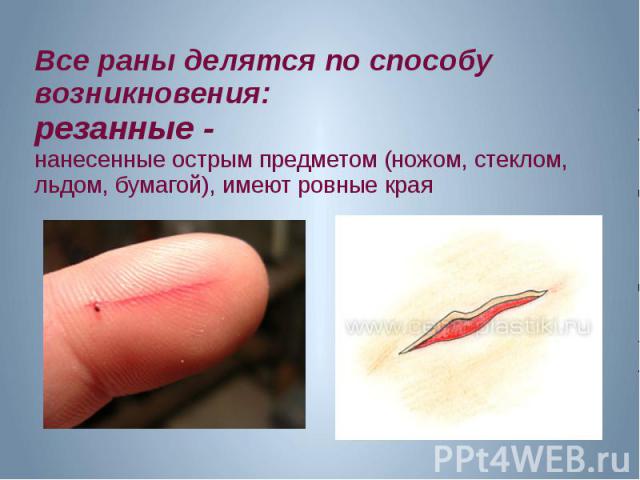 Все раны делятся по способу возникновения: резанные - нанесенные острым предметом (ножом, стеклом, льдом, бумагой), имеют ровные края