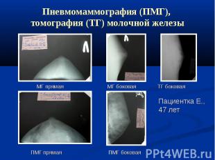 Пневмомаммография (ПМГ), томография (ТГ) молочной железы