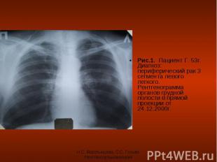 Рис.1. Пациент Г. 53г. Диагноз: периферический рак 3 сегмента левого легкого. Ре