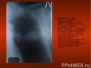 Пациент Г. 54г Рис.4. Прямая томограмма от 1.02 2002 г. Глубина среза 12,5 см. Р