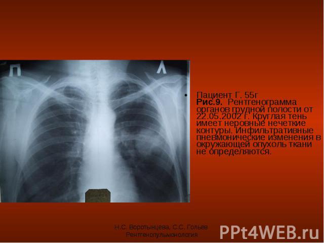 Пациент Г. 55г Рис.9. Рентгенограмма органов грудной полости от 22.05.2002 г. Круглая тень имеет неровные нечеткие контуры. Инфильтративные пневмонические изменения в окружающей опухоль ткани не определяются. Пациент Г. 55г Рис.9. Рентгенограмма орг…