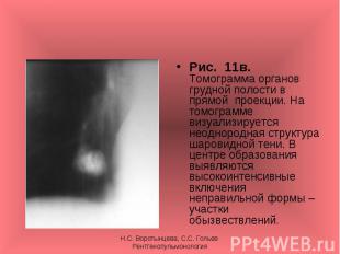 Рис. 11в. Томограмма органов грудной полости в прямой проекции. На томограмме ви