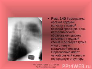 Рис. 14б Томограмма органов грудной полости в правой боковой проекции. Тень пато