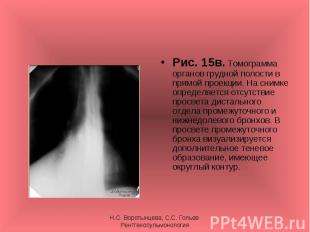 Рис. 15в. Томограмма органов грудной полости в прямой проекции. На снимке опреде