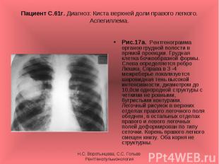 Рис.17а. Рентгенограмма органов грудной полости в прямой проекции. Грудная клетк