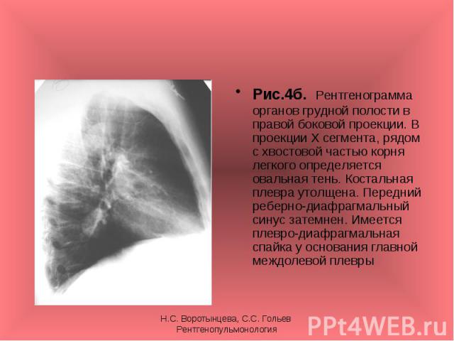 Рис.4б. Рентгенограмма органов грудной полости в правой боковой проекции. В проекции Х сегмента, рядом с хвостовой частью корня легкого определяется овальная тень. Костальная плевра утолщена. Передний реберно-диафрагмальный синус затемнен. Имеется п…
