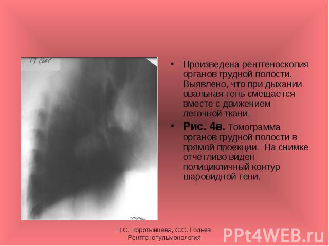 Произведена рентгеноскопия органов грудной полости. Выявлено, что при дыхании овальная тень смещается вместе с движением легочной ткани. Произведена рентгеноскопия органов грудной полости. Выявлено, что при дыхании овальная тень смещается вместе с д…