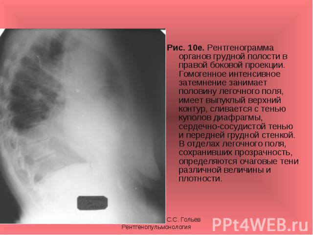 Рис. 10е. Рентгенограмма органов грудной полости в правой боковой проекции. Гомогенное интенсивное затемнение занимает половину легочного поля, имеет выпуклый верхний контур, сливается с тенью куполов диафрагмы, сердечно-сосудистой тенью и передней …