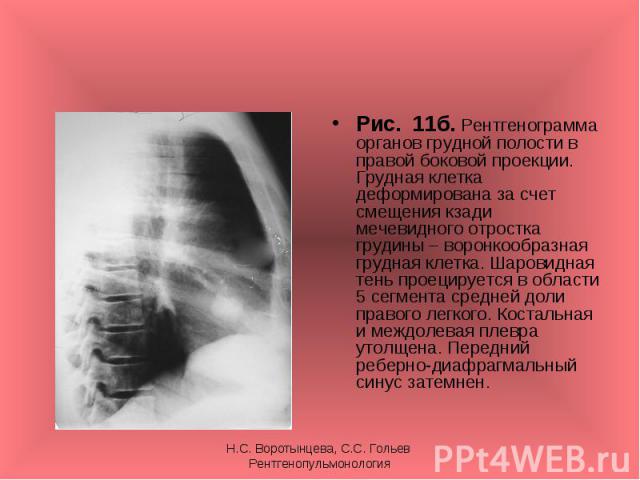 Рис. 11б. Рентгенограмма органов грудной полости в правой боковой проекции. Грудная клетка деформирована за счет смещения кзади мечевидного отростка грудины – воронкообразная грудная клетка. Шаровидная тень проецируется в области 5 сегмента средней …
