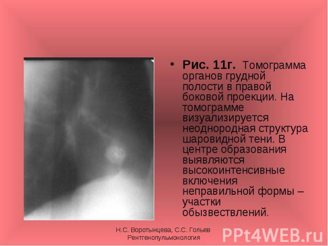 Рис. 11г. Томограмма органов грудной полости в правой боковой проекции. На томограмме визуализируется неоднородная структура шаровидной тени. В центре образования выявляются высокоинтенсивные включения неправильной формы – участки обызвествлений. Ри…
