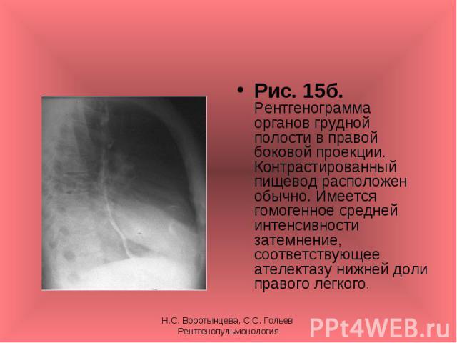 Рис. 15б. Рентгенограмма органов грудной полости в правой боковой проекции. Контрастированный пищевод расположен обычно. Имеется гомогенное средней интенсивности затемнение, соответствующее ателектазу нижней доли правого легкого. Рис. 15б. Рентгеног…