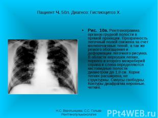 Рис. 10а. Рентгенограмма органов грудной полости в прямой проекции. Прозрачность