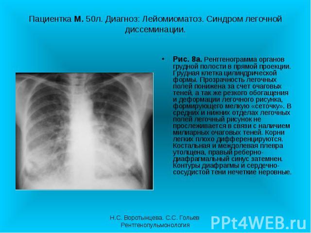 Рис. 8а. Рентгенограмма органов грудной полости в прямой проекции. Грудная клетка цилиндрической формы. Прозрачность легочных полей понижена за счет очаговых теней, а так же резкого обогащения и деформации легочного рисунка, формирующего мелкую «сет…