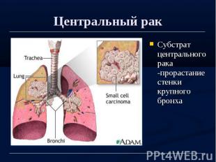 Центральный рак Субстрат центрального рака -прорастание стенки крупного бронха