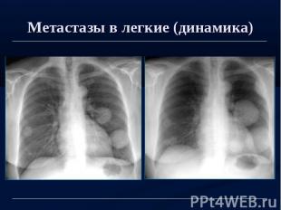 Метастазы в легкие (динамика)